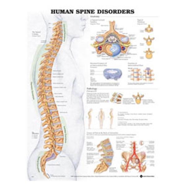 Wolters Kluwer Health  Chart Educational Human Spine Disorders 20x26" Ea