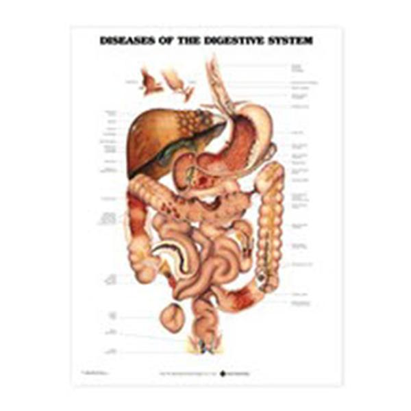 Wolters Kluwer Health  Chart Educational Diseases of The Digestive System Eng 20x26" Ea