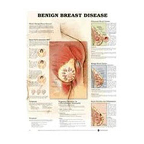 Wolters Kluwer Health  Chart Anatomical Benign Breast Disease 20x26" Ea