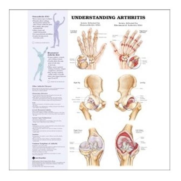 Wolters Kluwer Health  Chart Anatomical Arthritis/Joint 20x26" Ea