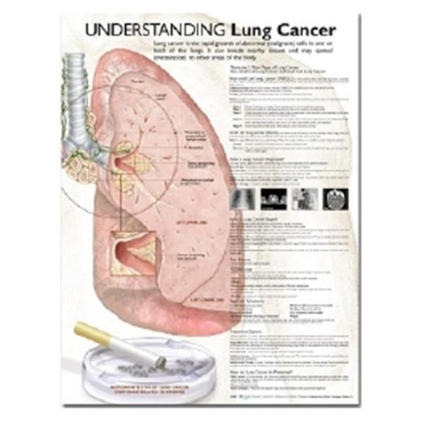 Wolters Kluwer Health  Chart Anatomical Understanding Lung Cancer English 20x26" Ea