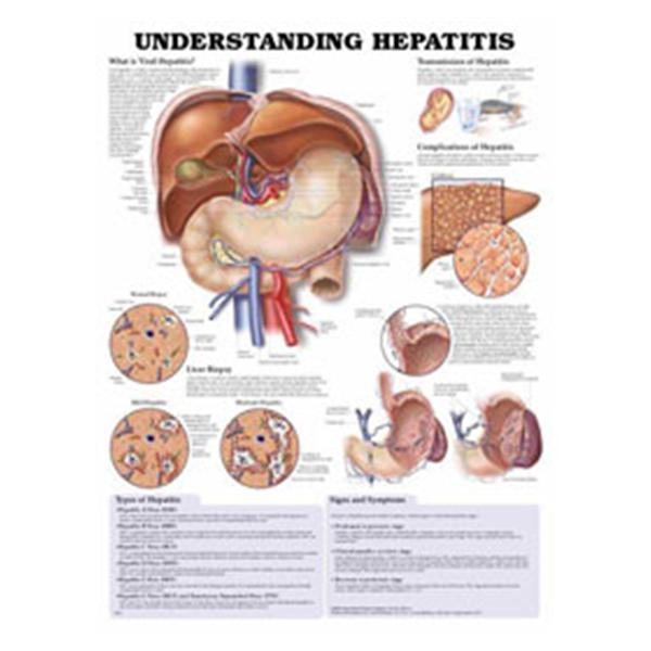 Wolters Kluwer Health  Chart Educational Understanding Hepatitis 20x26" Ea