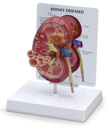 Nasco Kidney Models - MODEL, KIDNEY, W/PATH - SB46337U