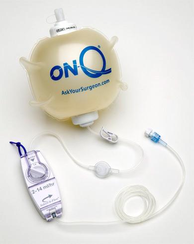 Halyard Health On-Q Painbuster Kits - On-Q Expansion Kit, 5" - PM020