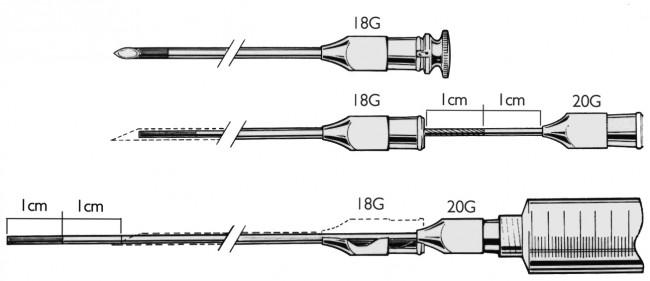 Rocket Medical Plc Chelsea & Westminster CVS Needle Sets - Chelsea Chorion Needle, Sterile - R57032