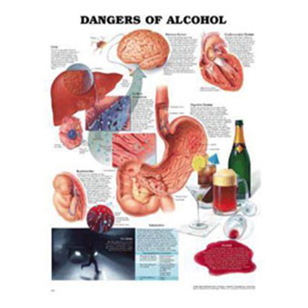 Wolters Kluwer Health  Chart Educational Dangers of Alcohol 20x26" Ea