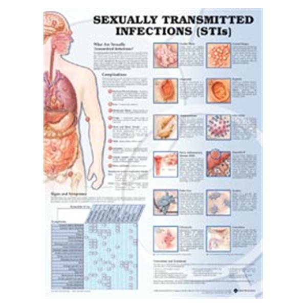 Wolters Kluwer Health  Chart Educational Sexually Transmitted Infections 20x26" Ea