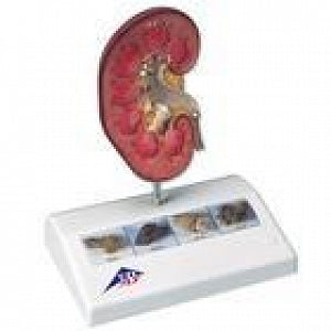 American 3B Scientific Kidney Stone Model - Kidney Stone Model - K29