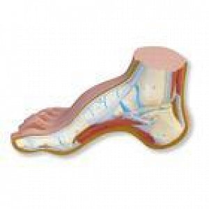 American 3B Scientific Hollow Foot (Pes Cavus) Model - Hollow Foot / Pes Cavus Model - M32