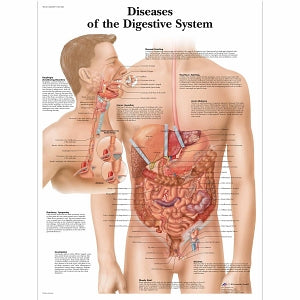 American 3B Scientific Educational Posters - POSTER, SYSTEM, DIGESTIVE, DISEASES, 2MICRON - VR1431L