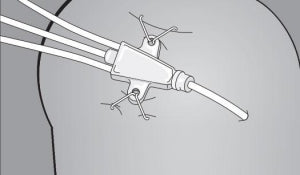 Teleflex Medical Staple Anchoring Devices - Staple Anchoring Device, 2-Staple - SD-00002