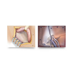 CR Bard Bard Soft Surgical Meshes - Soft Mesh, 12