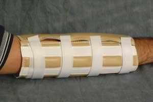 E. M. Adams Elbow Splints - Elbow Splint, Vinyl, 11", Size M - EP26-0421