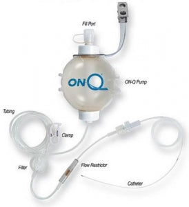 Avanos Medical ON-Q Pump Kits with ON-Q SilverSoaker Catheter - ON-Q Fixed Flow Pump Kit Pain Relief System with Dual SilverSoaker Antimicrobial Catheters, 270 mL, 4 mL / HR, 5" - PM025-A