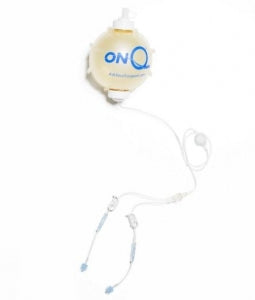 Avanos Medical ON-Q Pump Kits with ON-Q SilverSoaker Catheter - ON-Q Fixed Flow Pump Kit with SilverSoaker Catheter, 35", 270 mL - PM045-A