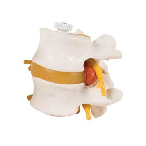 Fabrication Enterprises Spinal Column Models - Lumbar Vertebrae with Prolapsed Disc Model - 12-4595