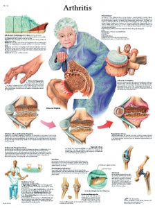 Fabrication Enterprises Inc Laminated Anatomical Charts - CHART, ANATOMICAL, ARTHRITIS, LAMINATED - 12-4605L