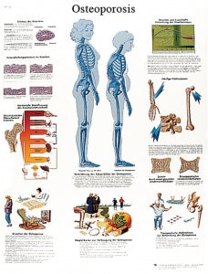 Fabrication Enterprises Inc Paper Anatomical Charts - CHART, ANATOMICAL, OSTEOPOROSIS, PAPER - 12-4615P