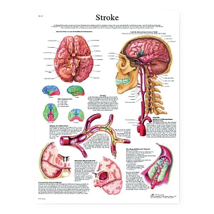 Fabrication Enterprises Inc Laminated Anatomical Charts - CHART, ANATOMICAL, STROKE, LAMINATED - 12-4629L