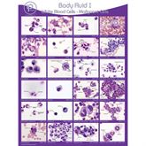 Body Fluid Pathology Reference Poster Body Fluid I: WBCs-Malignant Cells Poster