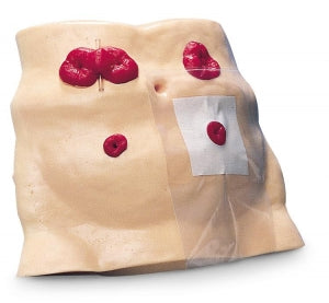 Nasco Global Ostomy Care Model - MODEL, OSTOMY CARE - SB23501U