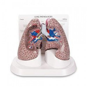 Nasco Lung Cancer Model - Lung Model with Cancer, 4-1/4" x 5-1/2" x 8-1/4" - SB44894G