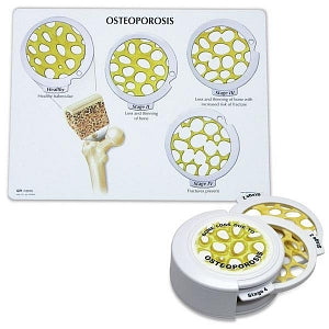 Nasco Osteoporosis Disk Educational Training Model - Osteoporosis Disk Educational Training Model, 4"D x 1-5/8" - SB48059HR