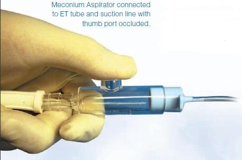 Meconium Aspirator by Neotech Products