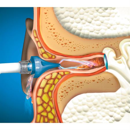 OtoClear Ear Irrigation Tip and Systems OtoClear Ear Irrigation Tips