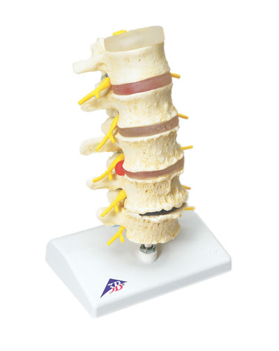 Vertebrae Degeneration