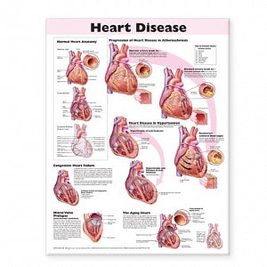 Wolters Kluwer Heart Disease Anatomical Chart - Heart Disease Anatomical Chart, English, Paper - 9780781773379