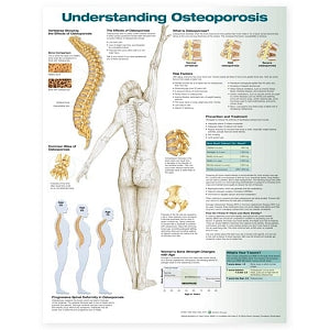 Wolters Kluwer Understanding Osteoporosis Anatomical Chart - Understanding Osteoporosis Anatomical Chart, Laminated - 9781496362483