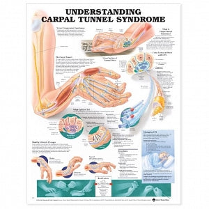 Wolters Kluwer Understanding Carpal Tunnel Anatomical Chart - Understanding Carpal Tunnel Anatomical Chart, Paper - 9781587793226