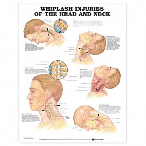 Wolters Kluwer Whiplash Injuries of the Head and Neck Anatomical Chart - Whiplash Injuries of the Head and Neck Anatomical Chart, Laminated - 9781587793752