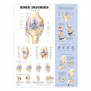 Wolters Kluwer Knee Injuries Anatomical Chart - Knee Injuries Anatomical Chart, Paper - 9781587797569