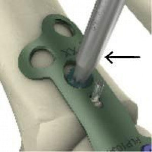 Medline ReNewal Reprocessed Memometal Drill Bit - XFO082501 @MEMOMETAL ST&ARD DRL BIT 2.5M - XFO082501RH