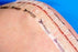 Zipline Medical Zip Surgical Skin Closures - Zip Surgical Skin Closure, 16 cm - PS1160